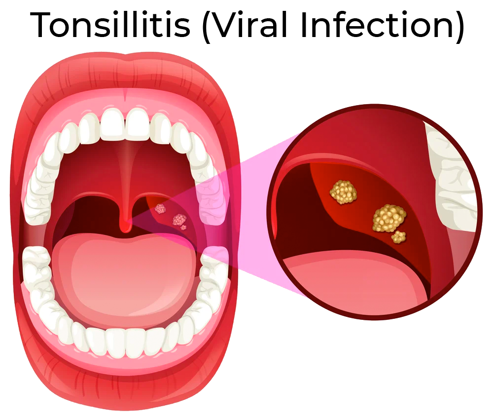 what-causes-tonsillitis-cv-ent-surgical-group